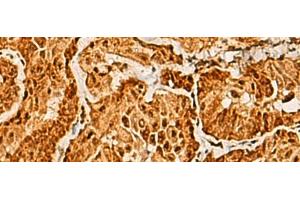 Immunohistochemistry of paraffin-embedded Human thyroid cancer tissue using SAP30BP Polyclonal Antibody at dilution of 1:40(x200)