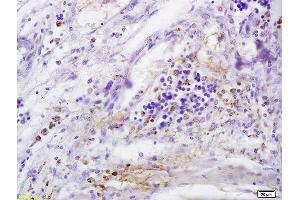 Formalin-fixed and paraffin embedded human cervical carcinoma labeled with Anti-CD146/MCAM Polyclonal Antibody, Unconjugated (ABIN732143) at 1:200 followed by conjugation to the secondary antibody and DAB staining (MCAM 抗体  (AA 201-300))