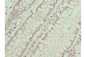 Immunohistochemistry of paraffin-embedded human colon cancer using ABIN7144195 at dilution of 1:100 (ASB7 抗体  (AA 1-274))