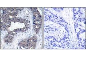 Immunohistochemistry analysis of paraffin-embedded human breast carcinoma tissue, using IRS-1 (Ab-307) Antibody. (IRS1 抗体  (AA 274-323))