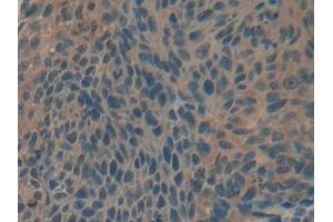 IHC-P analysis of Human Esophagus cancer Tissue, with DAB staining.