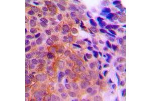Immunohistochemical analysis of CK1 gamma 1 staining in human breast cancer formalin fixed paraffin embedded tissue section. (CSNK1G1 抗体  (N-Term))