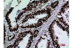 Immunohistochemistry (IHC) analysis of paraffin-embedded Human Colon Cancer, antibody was diluted at 1:100.