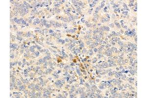 ABIN6264457 and ABIN6272976 at 1/100 staining Human breast cancer by IHC-P.