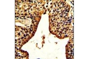 Formalin-fixed and paraffin-embedded human prostate carcinoma with VIP Antibody (C-term), which was peroxidase-conjugated to the secondary antibody, followed by DAB staining. (Vip 抗体  (C-Term))