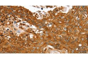 Immunohistochemistry of paraffin-embedded Human esophagus cancer tissue using ABCC8 Polyclonal Antibody at dilution 1:40 (ABCC8 抗体)