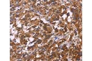 Immunohistochemical analysis of paraffin-embedded Human thyroid cancer tissue using at dilution 1/30. (KIR2DL3 抗体  (Internal Region))
