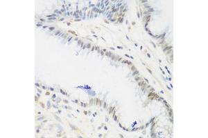 Immunohistochemistry of paraffin-embedded human stomach using IGF2BP3 antibody (ABIN5972501) at dilution of 1/200 (40x lens). (IGF2BP3 抗体)
