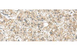 Immunohistochemistry of paraffin-embedded Human liver cancer tissue using PAPSS2 Polyclonal Antibody at dilution of 1:95(x200) (PAPSS2 抗体)