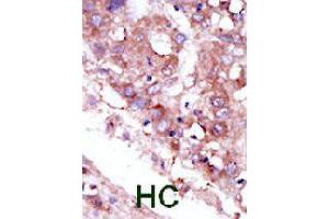 Formalin-fixed and paraffin-embedded human hepatocellular carcinoma tissue reacted with STK33 polyclonal antibody  , which was peroxidase-conjugated to the secondary antibody, followed by DAB staining. (STK33 抗体  (C-Term))