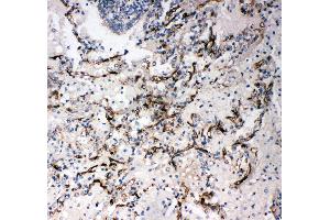 Anti-CD34 antibody, IHC(P) IHC(P): Human Lung Cancer Tissue