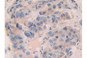 Detection of CNTN4 in Human Breast cancer Tissue using Polyclonal Antibody to Contactin 4 (CNTN4) (Contactin 4 抗体  (AA 731-980))