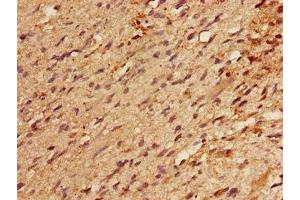 Immunohistochemistry of paraffin-embedded human glioma using ABIN7164177 at dilution of 1:100 (RBM22 抗体  (AA 2-250))