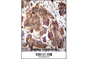 GLMN Antibody immunohistochemistry analysis in formalin fixed and paraffin embedded human bladder carcinoma followed by peroxidase conjugation of the secondary antibody and DAB staining.
