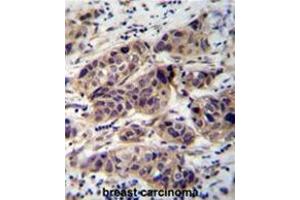 WDR42C Antibody (N-term) immunohistochemistry analysis in formalin fixed and paraffin embedded human breast carcinoma followed by peroxidase conjugation of the secondary antibody and DAB staining. (DCAF8L2 抗体  (N-Term))
