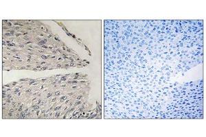 Immunohistochemistry analysis of paraffin-embedded human cervix carcinoma tissue using CIDEB antibody. (CIDEB 抗体  (Internal Region))