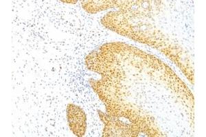 Formalin-fixed, paraffin-embedded human cervical cancer stained with p27Kip1 antibody (KIP1/769) (CDKN1B 抗体)
