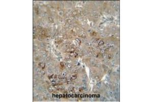 CES4 antibody (N-term) (ABIN654667 and ABIN2844363) immunohistochemistry analysis in formalin fixed and paraffin embedded human hepatocarcinoma followed by peroxidase conjugation of the secondary antibody and DAB staining. (CES1P1 抗体  (N-Term))