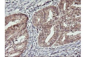 Immunohistochemical staining of paraffin-embedded Adenocarcinoma of Human endometrium tissue using anti-HLCS mouse monoclonal antibody. (HLCS 抗体)
