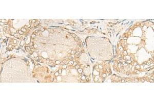 Immunohistochemistry of paraffin-embedded Human thyroid cancer tissue using DUSP27 Polyclonal Antibody at dilution of 1:50(x200) (DUSP27/STYXL2 抗体)