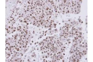 IHC-P Image Immunohistochemical analysis of paraffin-embedded OV90 xenograft, using FACA, antibody at 1:500 dilution. (FANCA 抗体  (N-Term))