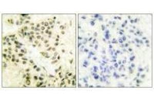 Immunohistochemical analysis of paraffin-embedded human breast carcinoma tissue using DNA-PK antibody. (PRKDC 抗体)
