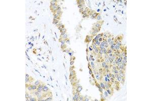 Immunohistochemistry of paraffin-embedded human lung cancer using DARS2 antibody at dilution of 1:100 (x40 lens). (DARS2 抗体)