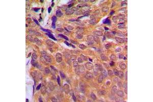 Immunohistochemical analysis of CHK1 staining in human breast cancer formalin fixed paraffin embedded tissue section. (CHEK1 抗体  (Center))