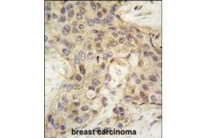 Formalin-fixed and paraffin-embedded human breast carcinoma tissue reacted with ANGEL2 antibody (Center) (ABIN389224 and ABIN2839377) , which was peroxidase-conjugated to the secondary antibody, followed by DAB staining. (ANGEL2 抗体  (AA 108-138))