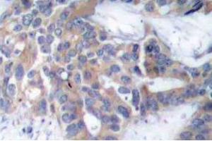 Immunohistochemistry (IHC) analyzes of p-MEK-1/2 antibody in paraffin-embedded human breast carcinoma tissue. (MEK1 抗体  (pSer218, pSer222))