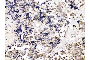 TRF2 was detected in paraffin-embedded sections of human lung cancer tissues using rabbit anti- TRF2 Antigen Affinity purified polyclonal antibody (Catalog # ) at 1 µg/mL. (TRF2 抗体  (AA 81-287))