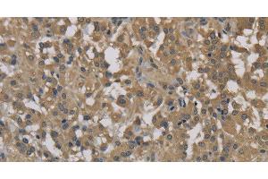 Immunohistochemistry of paraffin-embedded Human thyroid cancer tissue using DCTN3 Polyclonal Antibody at dilution 1:70 (DCTN3 抗体)