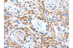 The image on the left is immunohistochemistry of paraffin-embedded Human esophagus cancer tissue using ABIN7191315(LRIG3 Antibody) at dilution 1/50, on the right is treated with synthetic peptide. (LRIG3 抗体)
