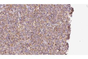 ABIN6273191 at 1/100 staining Human lymph cancer tissue by IHC-P. (alpha Adaptin 抗体  (Internal Region))