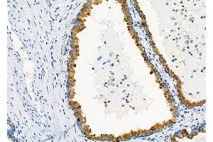 ABIN6258921 and ABIN6273360 at 1/100 staining Human prostate cancer by IHC-P. (GNG11 抗体  (N-Term))