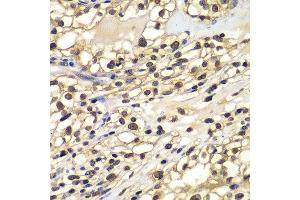 Immunohistochemistry of paraffin-embedded human kidney cancer using ZNF169 antibody at dilution of 1:100 (x400 lens). (ZNF169 抗体)