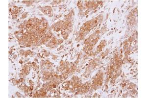 AP31125PU-N RGS10 antibody staining of Paraffin-Embedded Breast Carcinoma at 1/250 dilution. (RGS10 抗体  (AA 1-160))