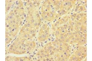 Immunohistochemistry of paraffin-embedded human liver cancer using ABIN7166614 at dilution of 1:100