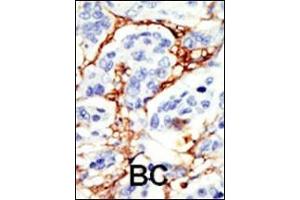 Formalin-fixed and paraffin-embedded human cancer tissue reacted with the primary antibody, which was peroxidase-conjugated to the secondary antibody, followed by DAB staining. (DOK2 抗体  (C-Term))