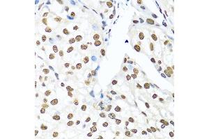 Immunohistochemistry of paraffin-embedded human prostate cancer using Ku80 antibody (ABIN6130932, ABIN6150308, ABIN6150310 and ABIN6217336) at dilution of 1:100 (40x lens). (XRCC5 抗体  (AA 540-732))