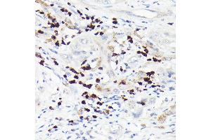 Immunohistochemistry of paraffin-embedded human liver cancer using MMP8 Rabbit pAb (ABIN3015770, ABIN3015771, ABIN3015772 and ABIN6219115) at dilution of 1:150 (40x lens). (MMP8 抗体  (AA 101-467))