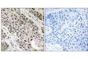Immunohistochemistry analysis of paraffin-embedded human lung carcinoma tissue using TNNI3K antibody. (TNNI3K 抗体  (Internal Region))