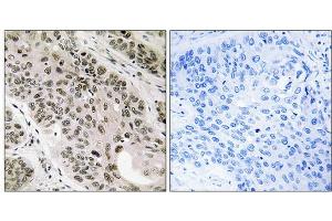 Immunohistochemistry analysis of paraffin-embedded human lung carcinoma tissue using TNNI3K antibody.