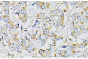 Immunohistochemistry of paraffin-embedded Human breast cancer using ATP5J Polyclonal Antibody at dilution of 1:100 (40x lens). (ATP5J 抗体)