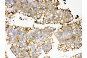 IHC testing of FFPE human kidney cancer tissue with APOA1 antibody. (APOA1 抗体)