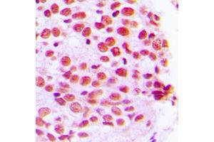 Immunohistochemical analysis of PE2 staining in human breast cancer formalin fixed paraffin embedded tissue section. (ERF 抗体  (C-Term))