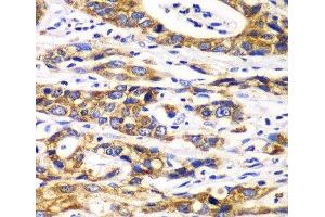 Immunohistochemistry of paraffin-embedded Human gastric cancer using RPN1 Polyclonal Antibody at dilution of 1:100 (40x lens). (RPN1 抗体)