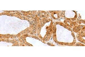 Immunohistochemistry of paraffin-embedded Human thyroid cancer tissue using RPS16 Polyclonal Antibody at dilution of 1:60(x200) (RPS16 抗体)