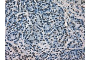 Immunohistochemical staining of paraffin-embedded Carcinoma of kidney tissue using antiHSPA9mouse monoclonal antibody. (HSPA9 抗体)