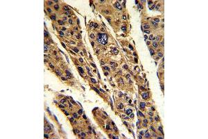 Formalin-fixed and paraffin-embedded human hepatocarcinoma reacted with TPT1 Antibody (Center), which was peroxidase-conjugated to the secondary antibody, followed by DAB staining. (TPT1 抗体  (AA 85-113))